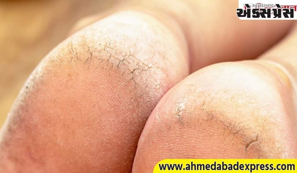 તમારે મોંઘા ક્રીમની જરૂર નહીં પડે; આ ઉપાયો તિરાડવાળી એડીઓને નરમ બનાવશે