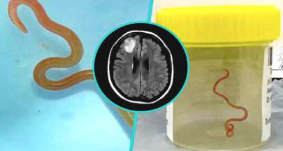 ઓસ્ટ્રેલિયન ડોકટરોએ દર્દીના મગજમાંથી 3-ઇંચનો જીવંત પરોપજીવી કૃમિ કાઢ્યો